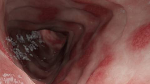 Managing Acute Severe Ulcerative Colitis (Video 5)