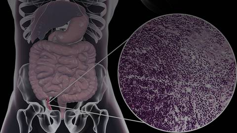 Crohn’s & Colitis Congress 2021: Assessing the Role of Immunomodulators in IBD