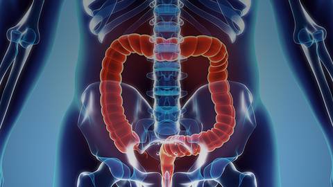 Perianal Fistulizing Crohn’s Disease (Video 7)