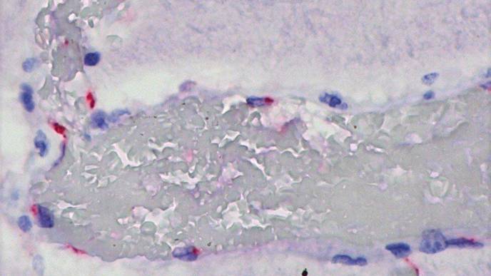 Direct Action of SARS-CoV-2 on Organs May Cause Exacerbated Immune Response in Children