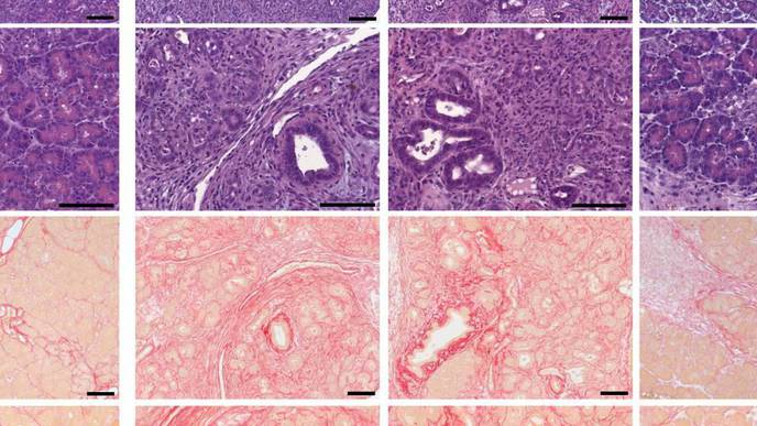 A Disease Trigger for Pancreatitis Has Been Identified