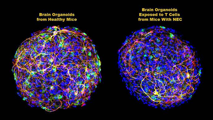 Study Finds Link Between Gut Disease & Brain Injury in Premature Infants