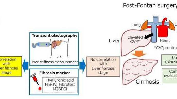 Post-Fontan Liver Fibrosis Goes Under the Radar