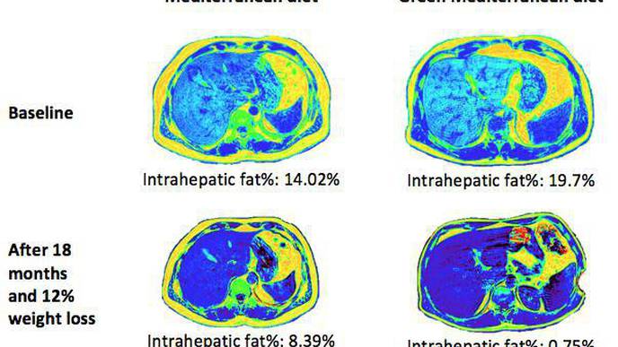 Green Med Diet Cuts Non-Alcoholic Fatty Liver Disease by Half