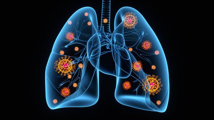 EU Evaluates Sobi Arthritis Drug to Treat COVID-19 with Pneumonia