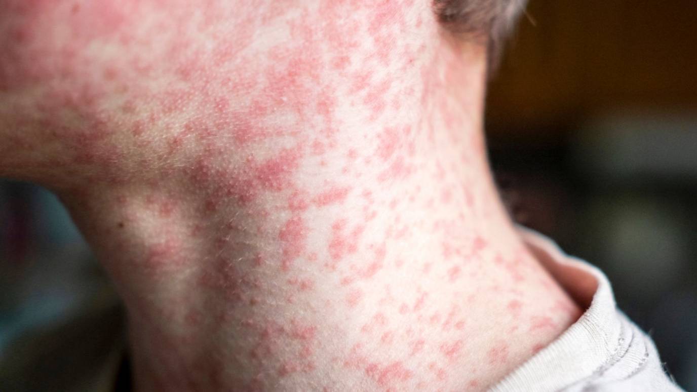 Colitus Rash Doctor on How to Avoid 'World’s Most Infectious Disease’ as Cases Soar ...