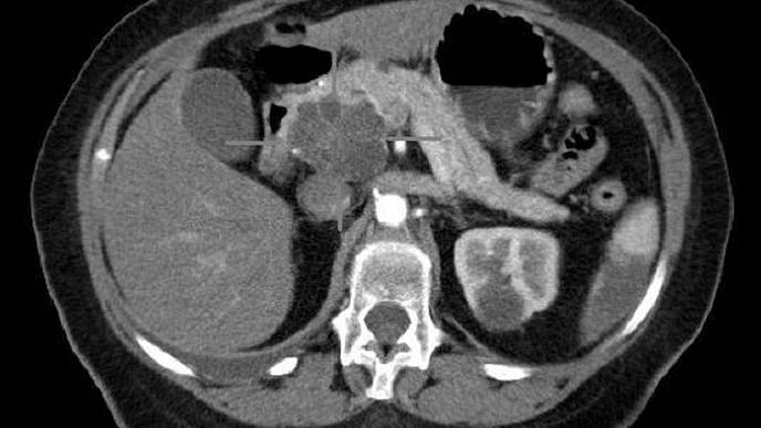 Immune Cells Assemble to Boost the Effects of Chemotherapy in Pancreatic Cancer