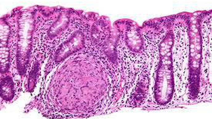 IBD Linked to Doubling in Dementia Risk
