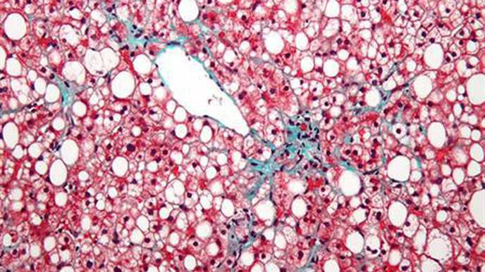 Novel Antisense Drug Shows Promise in Slowing Fatty Liver Disease